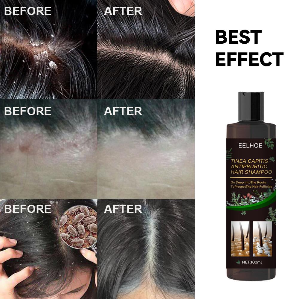 EELHOE Anti Dandruff Shampoo Itch Relief Hair Loss Prevention Oil Control