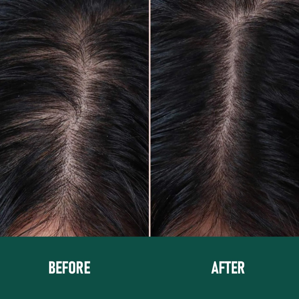 CH004 Minoxidil Anti Hair Loss Mousse Promotes Hair Growth